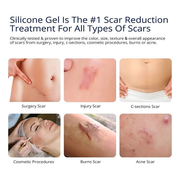 Gel Cicatrizante De Silicona Para Cicatrices Viejas Y Nuevas - Image 4