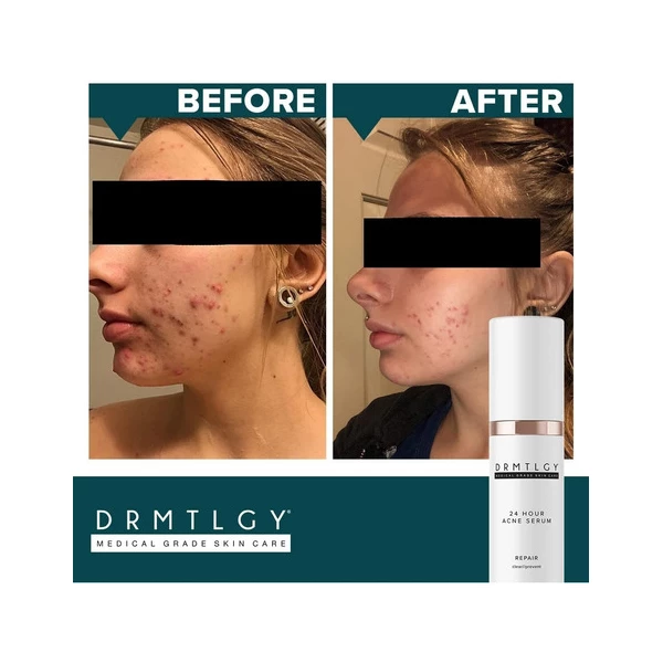 Drmtlgy Tratamiento De Manchas De Acné Y De Acné Quístico Tipo De Piel Todo Tipo De Piel - Image 4
